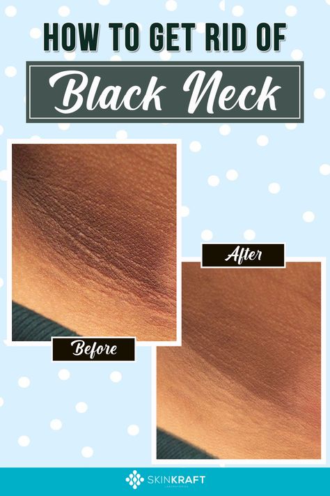 How To Get Rid Of Black Neck Neck Discoloration Remedies, Hyperpigmentation On Neck, Black Neck Remedies, Neck Hyperpigmentation, Neck Lightening, Dark Neck Remedies, Get Rid Of Dark Neck, Hyperpigmentation Remedies, Hyperpigmentation Black Skin