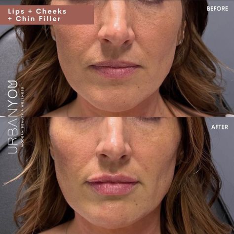 Lips, Cheeks, and Chin Filler | Before and After Lips With Filler, Chin Filler, Lip Enhancement, Lip Fillers, Dermal Fillers, Beautiful Lips, Beauty Wellness, A Face, The Secret