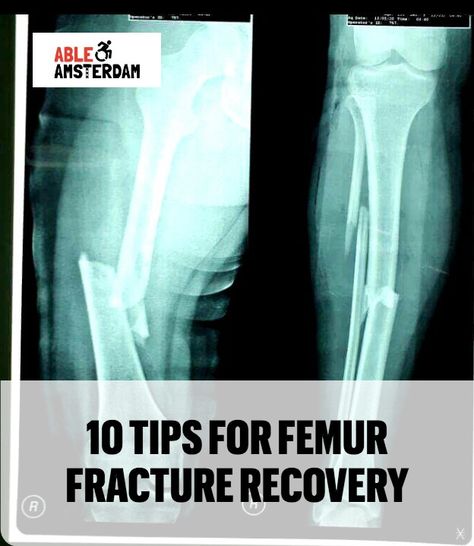 Here are my top tips to stay as comfortable and stress-free as possible during femur fracture recovery. Hip Fracture Recovery, Non Weight Bearing Exercises, Femur Fracture, Holistic Nursing, Physiotherapy Exercises, Femur Bone, Hip Strengthening Exercises, Hairline Fracture, Hip Fracture