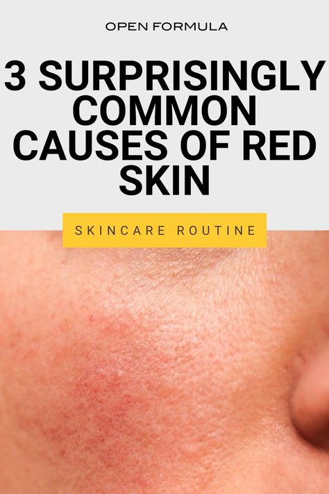 Do you know these three common causes of red skin? Here our tips for dealing with skin redness plus the best skincare products to use. What Helps With Redness On Face, Remedies For Redness On Face, Skincare Routine For Redness, Redness Relief Skin Care, Face Redness Remedy Diy, How To Get Rid Of Red Face, Red Skin Remedies Faces, Skincare Products For Redness, Best Products For Redness On Face