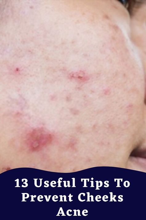 13 Useful Tips To Prevent Cheeks Acne Cheek Acne Cause, Acne On Cheeks, Chin Acne Causes, Nose Acne, Cheek Acne, Chin Acne, Cystic Acne Remedies, Dry Skin Acne, Forehead Acne