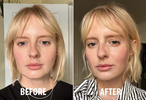 Chin Fillers Before After Round Face, Sharper Jawline, Mid 30s, Chin Filler, Juvederm Voluma, Thread Lift, Plastic Surgery Procedures, Numbing Cream, Brow Lift