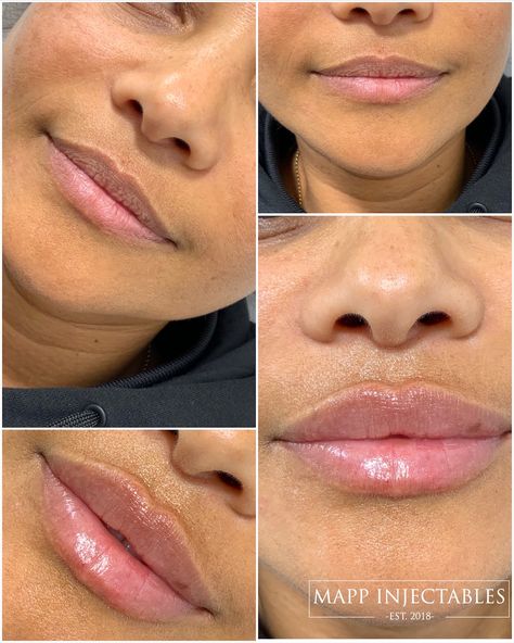 before and after lip photos Lip Fillers Before And After 1ml, Lip Filler Inspiration, Frown Wrinkles, 1ml Lip Filler, Beauty Maintenance, Hyaluronic Acid Lips, Chin Filler, Smokers Lines, Lips Inspiration