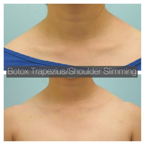 Trapezius Botox Before And After, Shoulder Botox Before And After, Botox Trapezius, Erbs Palsy, Botox Before And After, Facial Plastic, Bad Habit, Body Modification, Cosmetic Procedures