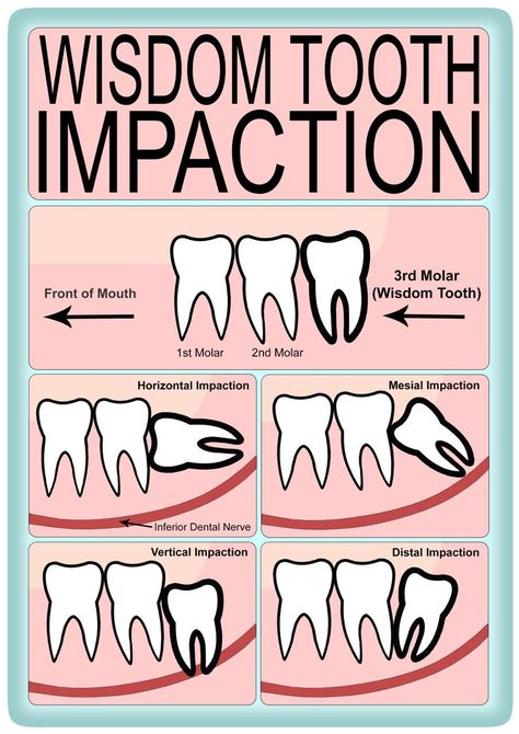 Wisdom Tooth Extraction, Wisdom Tooth, Lumbar Pain, Wisdom Teeth Removal, Dental Emergency, Tooth Removal, Tooth Pain, Tooth Extraction, Back Pain Exercises