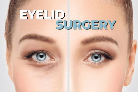 The Risks and Benefits of Eyelid Surgery - EZOnTheEyes Eyelid Surgeries, Hooded Eye Surgery, Hooded Eyelids, Droopy Eyelids, Keep Your Eyes Open, Peripheral Vision, Excess Skin, Upper Eyelid, Under Eye Wrinkles