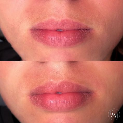 can we take a moment to appreciate her lip shape? 😅 . here i removed the hair from her upper lip using hard wax. hard wax is preferred for sensitive areas like the face, bikini line, & underarms. it allows you to go over the same spot multiple times without irritation, making the process more comfortable for your client. 😮‍💨 . #bellinghamesthetician #skincare #skin #waxing #haircare #estheticianstudent #waxinghairremoval #makeup #mua #explorepage #fypシ #fyp #nurseaesthetician #aesthetics #e... Skin Waxing, Upper Lip Waxing, Lip Waxing, Wax Hair Removal, Lip Shapes, Upper Lip, Esthetician, The Face, Hair Care