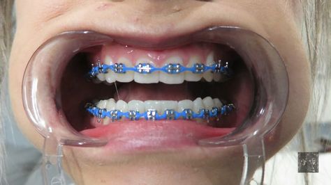 Powerchain Braces Green, Power Chain Braces Colors Ideas, Power Chain Braces Colors, Braces Colors Ideas Power Chains, Powerchain Braces Color, Sky Blue Braces, Royal Blue Braces, Chain Braces, Colored Braces