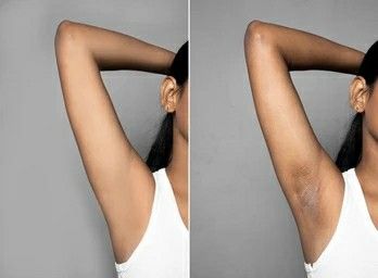 Practical steps that helps in clearing dark armhole Get Rid Of Dark Armpits, Bamboo Charcoal Soap, Dark Armpits, Cream For Dark Spots, Dark Underarms, Charcoal Soap, Fade Dark Spots, Remove Dark Spots, Skin Healing