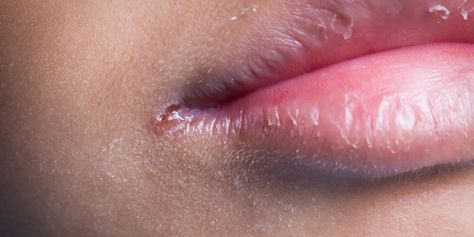 Meet your mouth’s nemesis: angular cheilitis. If you have cracks around your mouth, here's how to fix them. Corners Of Mouth Turned Down, Chapped Skin Around Mouth, Mouth Sore Remedy Kids, Angular Cheilitis Remedy Natural, Cracks In Corner Of Mouth, Dry Skin Around Mouth, Cracked Lip Corners, Cut On Lip, Cracked Corners Of Mouth