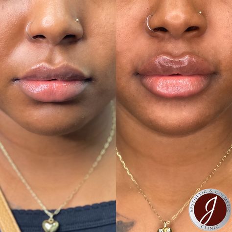 Lipolysis Injections Before And After, Needleless Lip Filler, Russia Lip Filler, Half Syringe Lip Filler Before And After, Russian Lips Filler Before And After, Lip Injections Before And After, Lip Flip Botox Before And After, Lip Fillers Before And After 1ml, 0.5 Ml Lip Filler Before And After