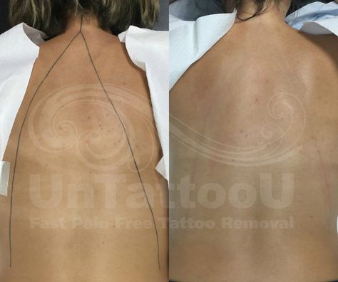 Before & After [All black professional tattoo located on clients back. Approximately 1 square inch in size. Age of tattoo: 5 years.]  #lasertattooremoval #picosure #tattooregret #tattooremoval #tattoos No Regrets Tattoo, Laser Tattoo, Laser Tattoo Removal, Free Tattoo, Professional Tattoo, Tattoo Removal, Backless Dress Formal, Maryland, All Black