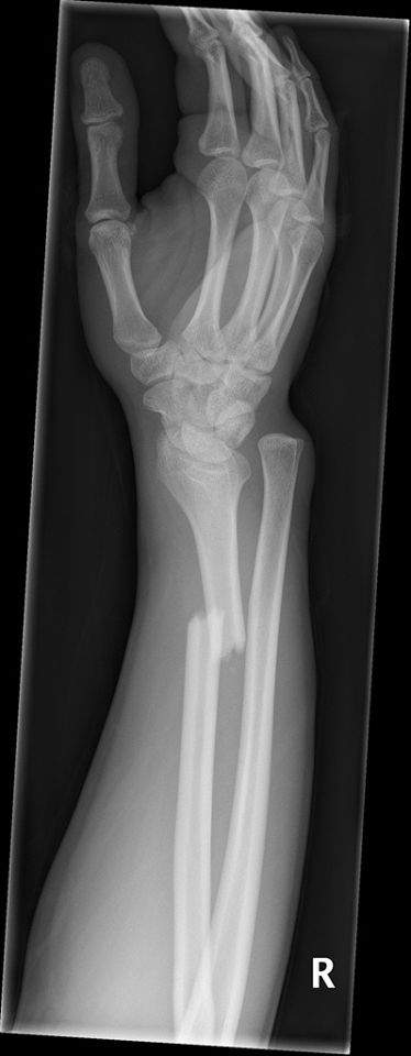 Open Fracture, Tumblr Feed, Broken Arm, Beauty Remedies, Forensic, Radiology, X Ray, Free Online, Ballet Shoes