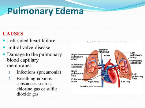 Advanced Pathophysiology, Edema Causes, Lungs Anatomy, General Medicine, Lung Anatomy, Ems Training, Nursing Classes, Mitral Valve, New Grad Nurse