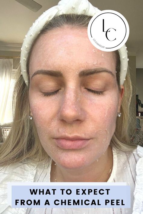 Chemical Peel Aesthetic, Chemical Peel Before And After, Chemical Peel Benefits, Chemical Face Peel, Glycolic Peel, Aesthetic Dermatology, Face Peel, Chemical Peels, Facial Peel