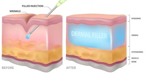 The Difference Between Profhilo vs Fillers vs Botox - SL Aesthetic Clinic Injection Illustration, Cosmetic Injections, Filler Injection, Mini Face Lift, Facial Procedure, Hyaluronic Acid Fillers, Botulinum Toxin, Cosmetic Injectables, Anti Aging Body