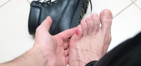 Blood blisters are harmless and heal on their own over time. There are, however, certain things you should and shouldn’t do if you have one. How To Get Rid Of Blisters On Feet Fast, How To Tape Feet For Blisters, How To Heal Blisters On Feet Fast, Prevent Blisters From Shoes, Blood Blister, Cold Pack, Blood Vessels, Healing Process, New Skin