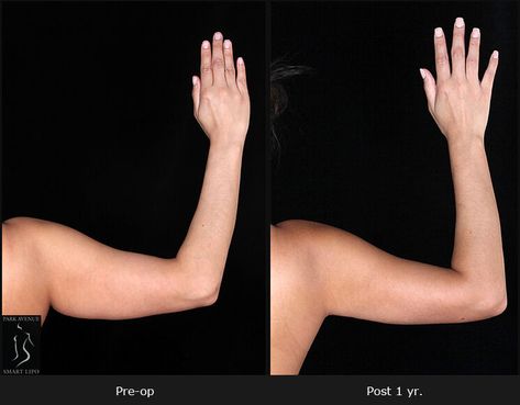 To maintain long-term outcomes of #ArmLiposuction in #NYC, it is essential to follow post-operative guidelines, maintain a healthy lifestyle, and stay at an optimal body weight. https://www.parkavenuesmartlipo.com/blog/does-arm-fat-return-after-liposuction/ Arm Lift Surgery, Lipo Before And After, Smart Lipo, Sagging Neck, Laser Lipo, Tighten Loose Skin, Arm Lift, Arm Fat, Cosmetic Procedures