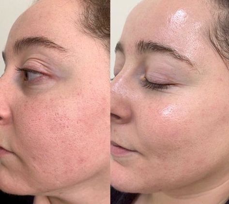 Face Injections, After Microneedling, Skin Care Pictures, Cosmetic Injectables, Facial Aesthetics, Before After Photo, Videos Aesthetic, Esthetician, Skin Treatments