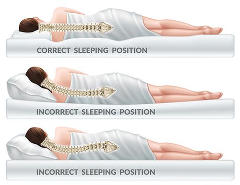 Sleeping Positions for Back and Neck Pain - Edison Spine Center Sleeping Pose, Sleep Posture, Neck Relief, Fetal Position, Correct Posture, Back Hurts, Muscle Imbalance, Sleeping Positions, Low Back Pain