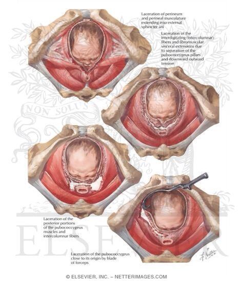 Midwife Art, Perineal Tear, Fertile Woman, Basic Anatomy And Physiology, Call The Midwife, Human Body Anatomy, Childbirth Education, Biology Lessons, Nursing School Tips