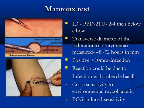 Mantoux test / PPD Mantoux Test, Medical Assistant Student, Nclex Prep, Subcutaneous Tissue, Nursing School Graduation, Phlebotomy, Medical Assistant, Nclex, Medical Information