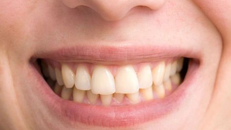 Cosmetic Dentistry Veneers, Teeth Whitening Homemade, Discolored Teeth, Teeth Whitening Remedies, Teeth Whitening Toothpaste, Laser Teeth Whitening, Charcoal Teeth Whitening, Pasta Dental, Yellow Teeth