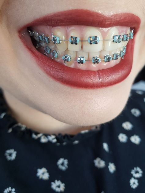 Dental Braces Colors, Teeth Aesthetic, Adult Braces, Cute Braces Colors, Orthodontic Appliances, Braces Tips, Braces Girls, Cute Braces, Dental Braces