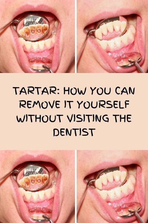 How you can remove it yourself without visiting the dentist 15 best tips Tongue Health, Stronger Teeth, Oral Care Routine, The Dentist, Oral Health Care, Lose 40 Pounds, Tooth Decay, Natural Home Remedies, Oral Hygiene