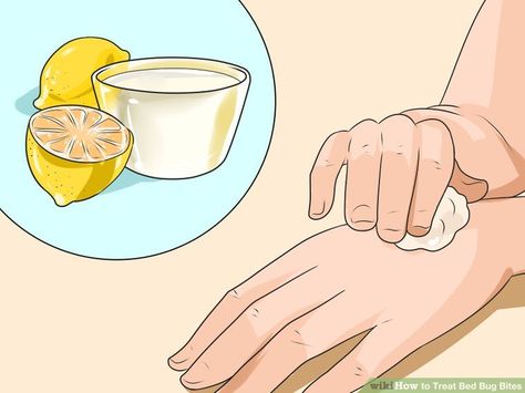 How to Treat Bed Bug Bites: 12 Steps (with Pictures) - wikiHow Daytime Bed, Bed Bug Bites Remedies, Bed Bug Bites Pictures, Bug Bites Remedies, Rid Of Bed Bugs, Bed Bug Bites, Bed Bug, Bug Bites, Learning Techniques