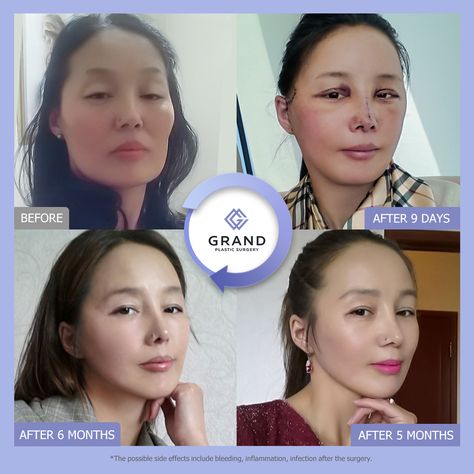 Cheekbone Reduction, Square Jaw, Change Appearance, Face Fat, Double Eyelid, Face Lift, Anime Edits, Free Consultation, Plastic Surgery