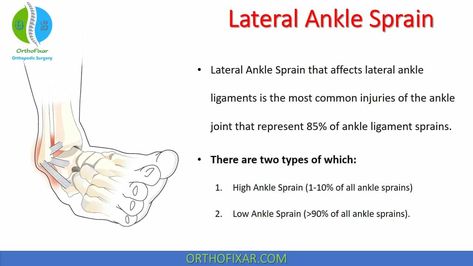 Lateral Ankle Sprain • Easy Explained - OrthoFixar 2022 High Ankle Sprain, Ankle Ligaments, Coordination Exercises, Ankle Sprain, Ligament Tear, Ligament Injury, Ankle Injury, Orthopedic Surgery, Sprained Ankle