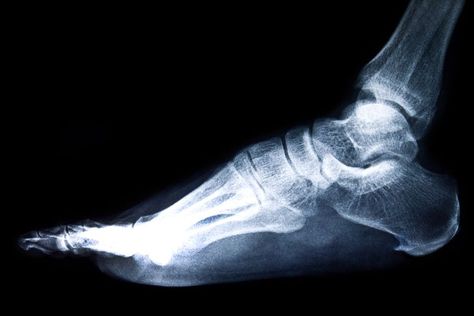 ¿Qué es el espolón calcáneo? El espolón calcáneo es un crecimiento del hueso del talón en forma triangular o de lanza. Ankle Replacement, Calcium Supplements, Fall Prevention, Do Exercise, Digestion Problems, Health Conditions, X Ray, Natural Health, Health