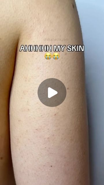 The Derma Co, Chemical Exfoliant, Strawberry Skin, Remove Skin Tags Naturally, Strawberry Legs, Chemical Exfoliation, Ginger Smoothie, Keratosis Pilaris, Skincare Benefits