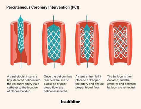 Cardiac Rehabilitation, Acute Coronary Syndrome, Chest Discomfort, Coronary Artery, Kidney Damage, Coronary Arteries, Men’s Health, Success Rate, Clinical Trials