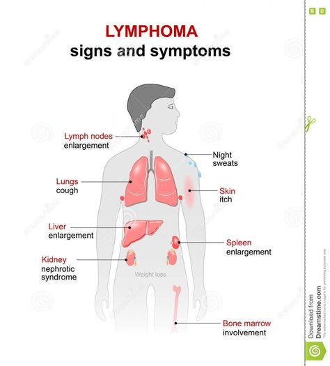 Lymphoma symptoms Hodgkin Vs Non Hodgkin Lymphoma, Non Hodgkins Follicular Lymphoma, Lymphoma Symptoms Signs, Lymphoma Diet, Waldenstrom Macroglobulinemia, Biomedical Illustration, Lymphoma Tattoo, Burkitt's Lymphoma, Severe Neck Pain