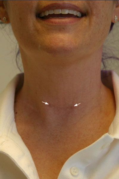 Parathyroid Surgery, Surgery Scar Quotes, Post Thyroidectomy, Thyroid Surgery Scar, Total Thyroidectomy, Thyroid Surgery, After Surgery, 3 Months, Surgery