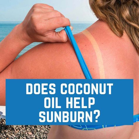 Does Coconut Oil Help Sunburn? Help Sunburn, Coconut Oil For Sunburn, Best For Sunburn, How To Help Sunburn, Severe Sunburn, Burn Remedy, Heal Sunburn, Swollen Face, Sunburn Remedies