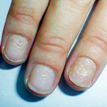 Watch out for these changes to your fingernails. Dents In Nails, Bumpy Nails, Pitted Nails, Nail Disorders, Nail Problems, Nail Infection, Fungal Nail, Nail Art For Beginners, Damaged Nails