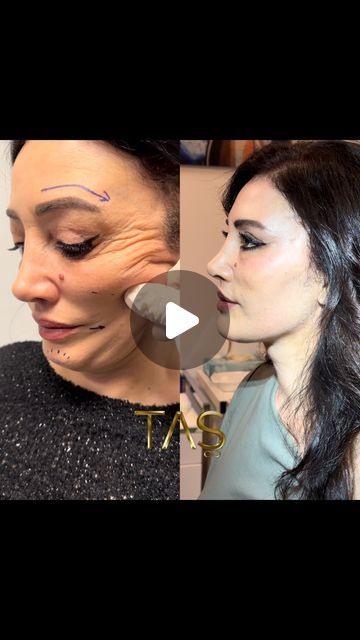 54K views · 3.1K likes | Prof.Dr. Süleyman Taş on Instagram: "She had 2 failed facelift with someone else and she is a wife of plastic surgeon. Being of plastic surgeons’s choice is definitely a honor for me and I appreciate for their trust 🙏 #drsuleymantas #revisionfacelift" Plastic Surgeon Photoshoot, Plastic Surgery Vision Board, Surgeon Female, Failed Plastic Surgeries, Best Plastic Surgeons, Plastic Surgeon, Someone Elses, Instagram