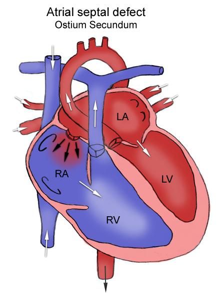 Heart Palpitations Causes, Atrial Septal Defect, Pericardial Effusion, Anatomy Heart, Heart Project, Congenital Heart Defect, Cardiac Nursing, Heart Defect, Heart Palpitations