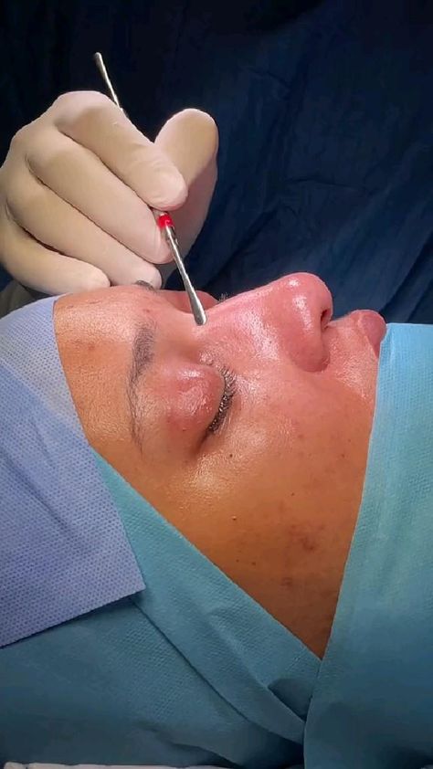 I happen to live and connect with best surgeons in Turkey. if you need to book any cosmetic surgery let me know and I will connect you with the best surgeons here in a Turkey. This video is from Dr .Mohammed Beautiful Nose, Rhinoplasty Before And After, Travel Pose, Nose Surgery, B Roll, Cosmetic Surgery, Let Me Know, Surgery, Let Me