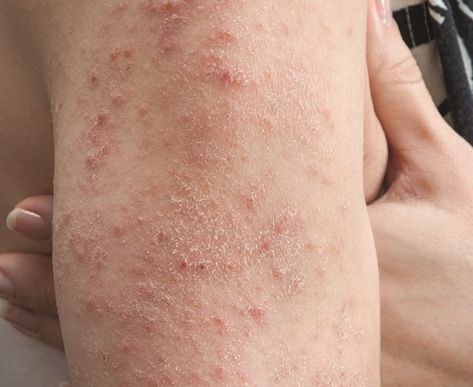 Celiac That's Skin Deep: The Mysterious Rash Sparked by Gluten Gluten Allergy Rash, Allergy Rash, Itchy Skin Rash, Celiac Symptoms, Itchy Rash, Skin Facts, Gluten Allergy, Skin Allergies, Itchy Skin