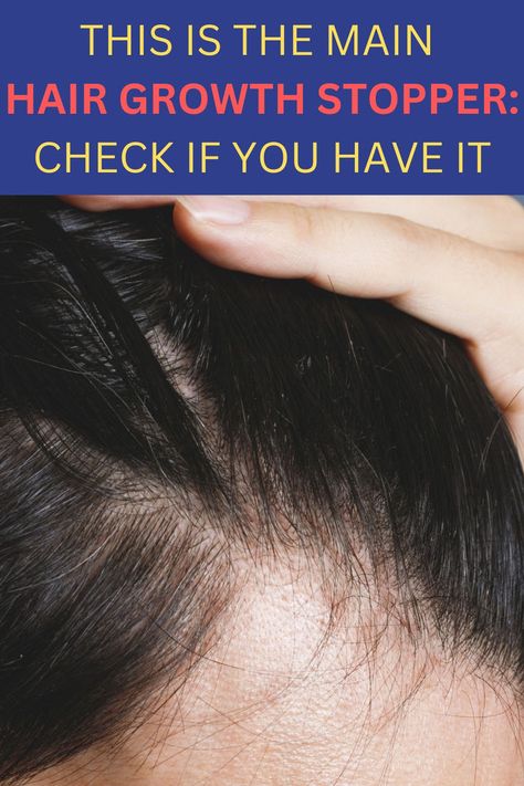 Regrow Lost Hair, Hair Nutrition, Thicker Fuller Hair, Bald Patches, Hair Growth Cycle, Hair Remedies For Growth, Regrow Hair, Lost Hair, Fuller Hair