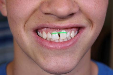 Some people may try to close a gap between their teeth with rubber bands- this can damage roots & even lead to tooth loss. Lifetime costs to restore missing teeth can exceed $20,000.  Moving teeth is a medical procedure & needs the personal supervision of an orthodontist. Contact us at 248-391-4477 or visit our website at: http://dehaanortho.com/ Gap Band, Adult Braces, Invisalign Braces, Gap Teeth, Ginger Smoothie, Missing Teeth, Liver Detoxification, Pediatric Dentistry, Fat Burning Foods