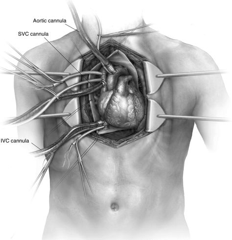 Cardiac Autotransplantation - Operative Techniques in Thoracic and Cardiovascular Surgery Cardio Thoracic Surgery Aesthetic, Surgery Illustration, Thoracic Surgery, Heart Facts, Cardiac Surgeon, Heart Structure, Mitral Valve, Medical Wallpaper, Google Scholar