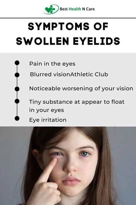 Eye swelling is a symptom of conditions like allergy and infection. Eye swelling is often accompanied with excess tear production, eye irritation/itching, dry eyes and sensitivity to light. How To Get Rid Of Swollen Eyes, Eye Allergies Remedies, Essential Oils For Eye Infection, Swollen Eyes From Allergies, Eye Infection Symptoms, Swollen Eyelid, Swollen Eyes, Eye Infections, Bacterial Infection