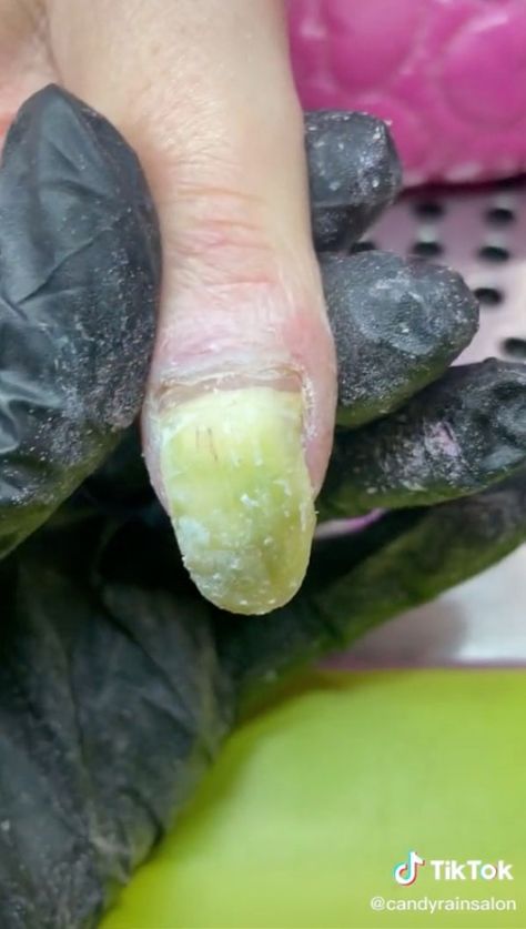 A NAIL technician shared a video of her client’s severely damaged nails – they’ve turned green, they’re lifting off, and she’s had to cut one of them right back to the cuticle. Candy Rain Salon, based in Plymouth, shared the video, which showed the effects of repeatedly getting acrylic applied over damaged nails. Nail tech […] Damaged Nails After Acrylics, Nail Fails, Remove Fake Nails, Nail Disorders, Nails After Acrylics, Candy Rain, Fail Nails, Bad Nails, Short Nail Manicure