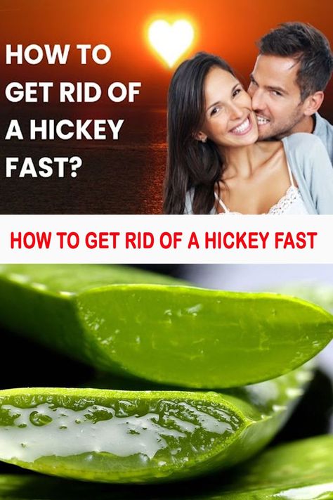 A Quick Guide On How To Get Rid of a Hickey Fast How To Get Rid Of A Hickey Fast, How To Get Rid Of Hickeys Quickly, Relation Ship, What Can I Do, Silly Pictures, Quick Guide, Why People