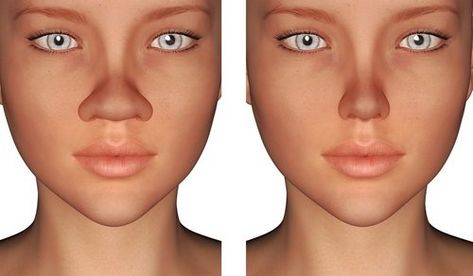 Rhinoplasty, more simply referred to as a nose job, is a plastic surgery procedure that by now, we have all ... Rhinoplasty Nose Jobs, Face Fillers, Facial Bones, Rhinoplasty Before And After, Rhinoplasty Surgery, Pretty Nose, Wide Nose, Beauty Procedures, Perfect Nose